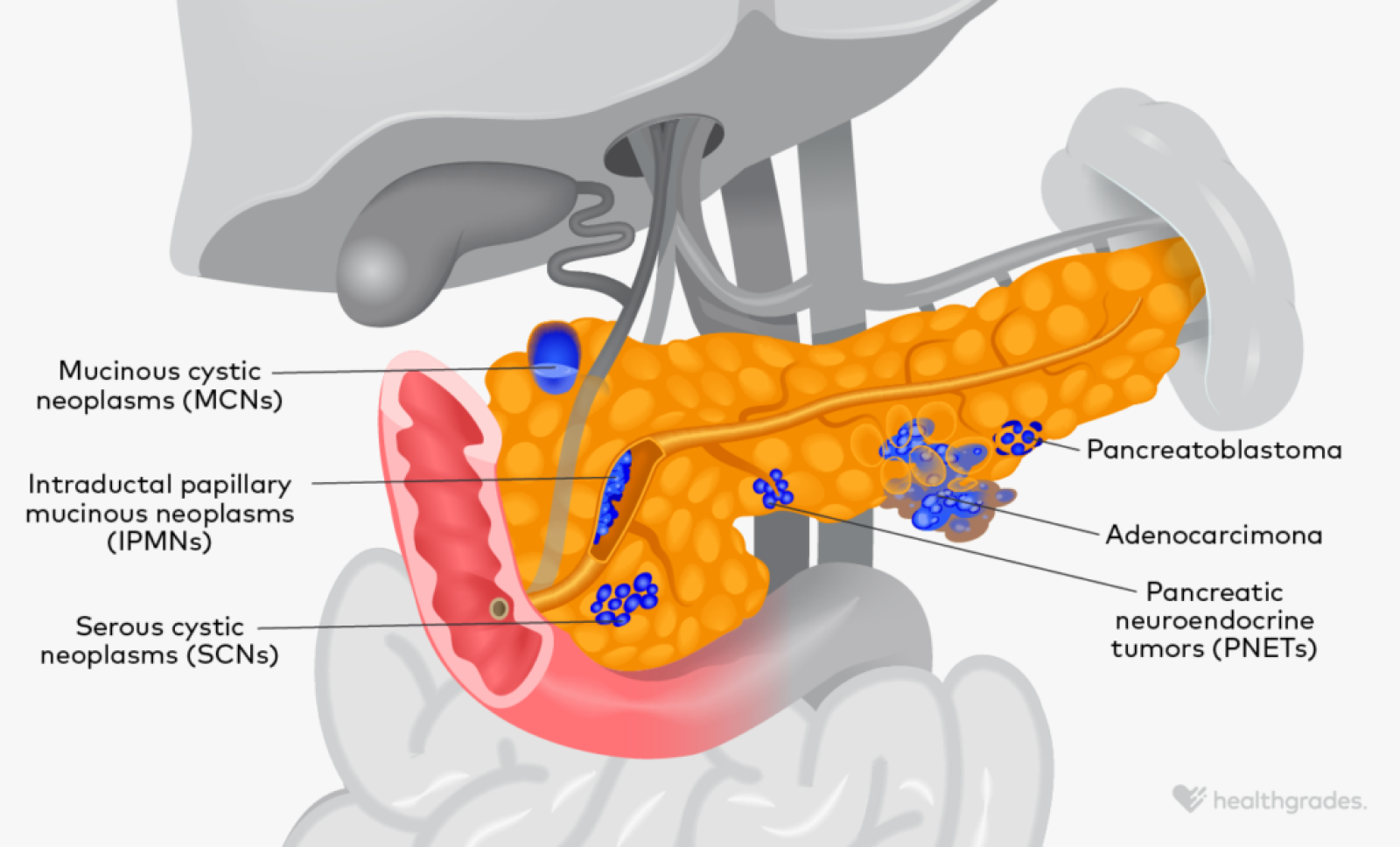 Types of Pancreatic Cancer: Symptoms, Treatment, and More